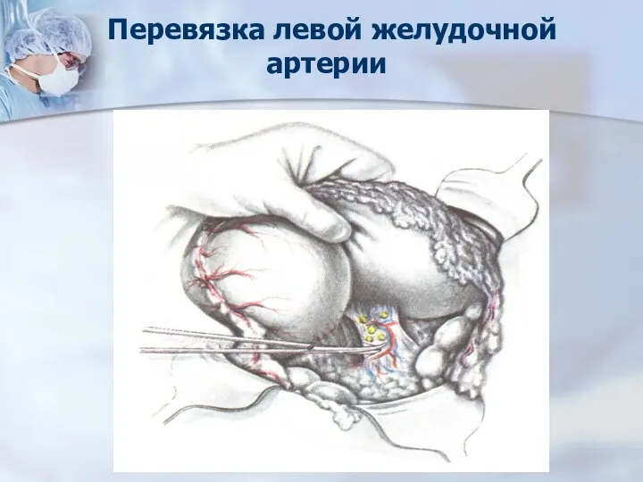 Перевязка левой желудочной артерии
