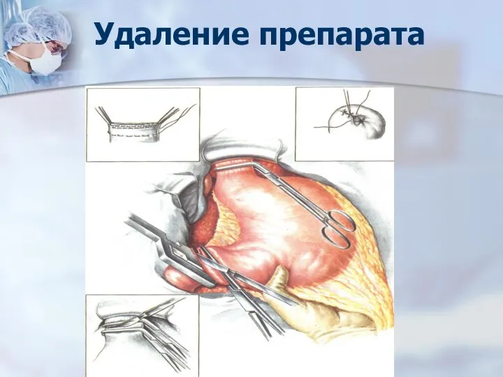 Удаление препарата