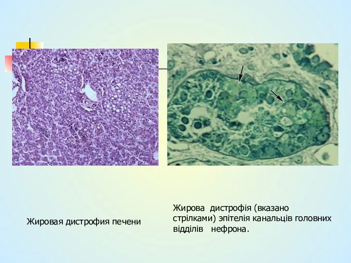Жировая дистрофия печени Жирова дистрофія (вказано стрілками) эпітелія канальців головних відділів нефрона.