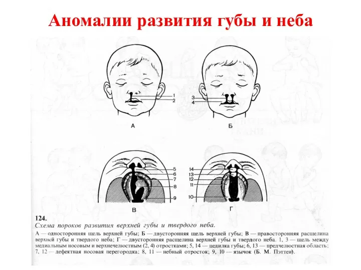 Аномалии развития губы и неба