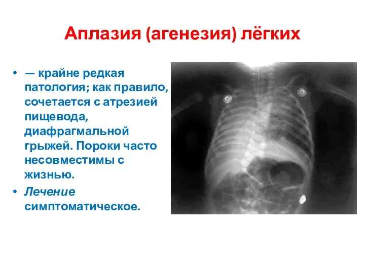 Аплазия (агенезия) лёгких — крайне редкая патология; как правило, сочетается