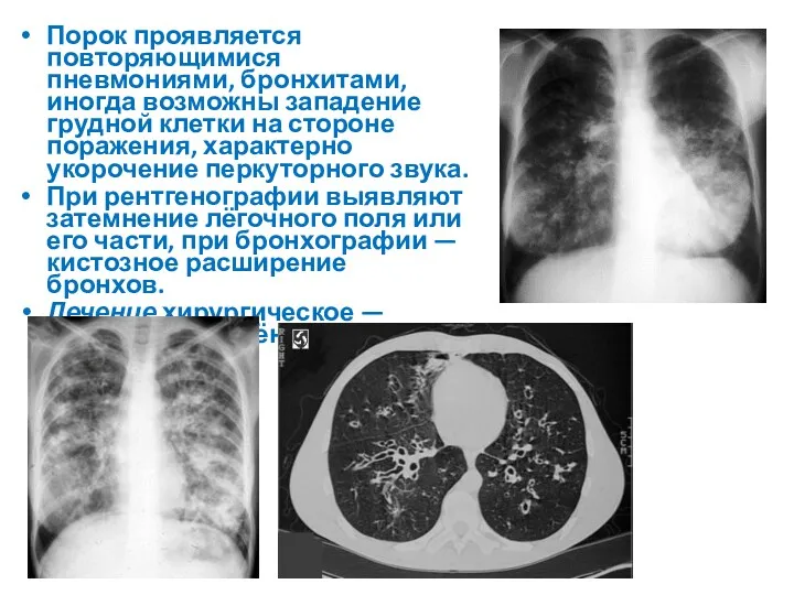 Порок проявляется повторяющимися пневмониями, бронхитами, иногда возможны западение грудной клетки