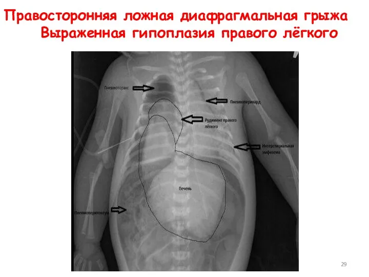 Правосторонняя ложная диафрагмальная грыжа Выраженная гипоплазия правого лёгкого