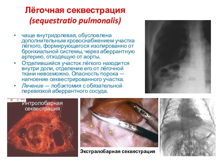 Лёгочная секвестрация (sequestratio pulmonalis) чаще внутридолевая, обусловлена дополнительным кровоснабжением участка