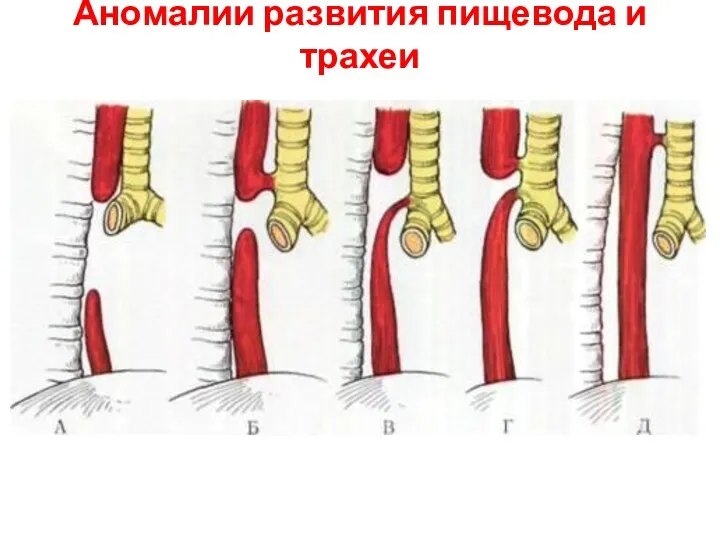 Аномалии развития пищевода и трахеи