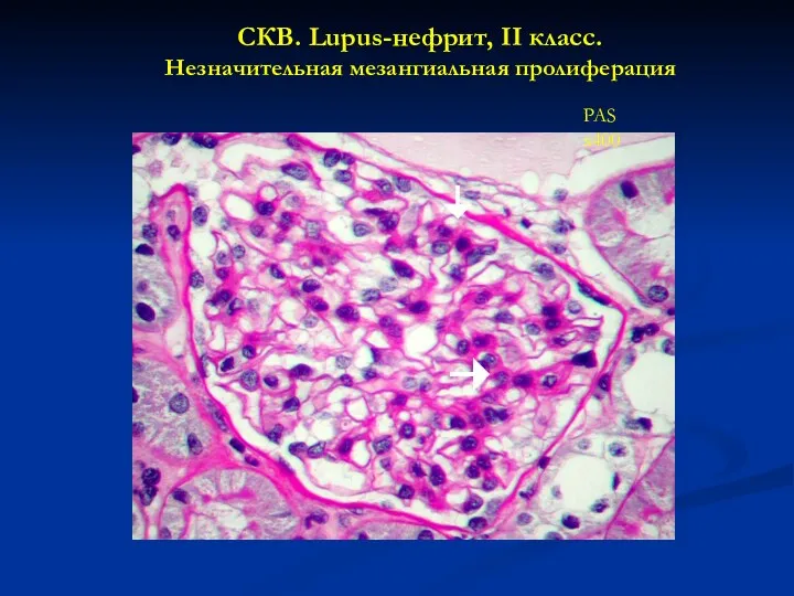 СКВ. Lupus-нефрит, II класс. Незначительная мезангиальная пролиферация PAS x400