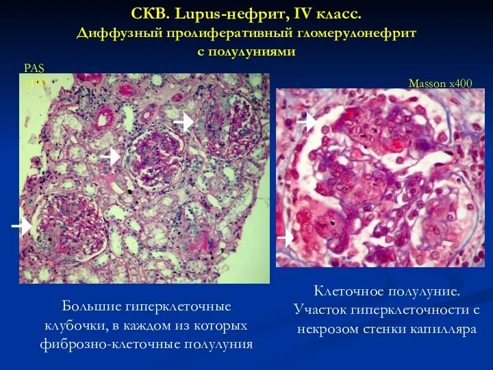 СКВ. Lupus-нефрит, IV класс. Диффузный пролиферативный гломерулонефрит с полулуниями Masson