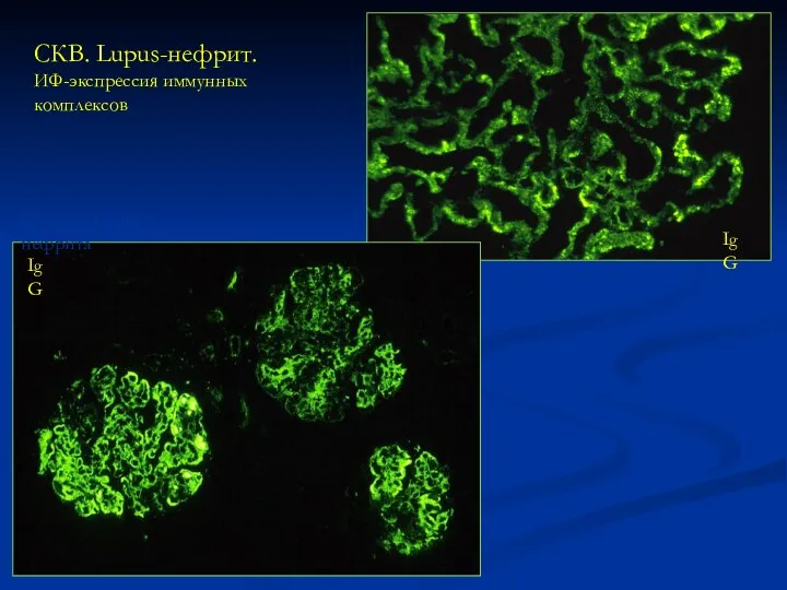 СКВ. Lupus-нефрит. ИФ-экспрессия иммунных комплексов IV класс Lupus-нефрита V класс Lupus-нефрита IgG IgG