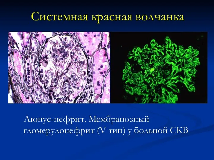 Люпус-нефрит. Мембранозный гломерулонефрит (V тип) у больной СКВ Системная красная волчанка