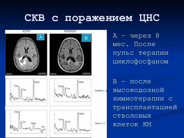 СКВ с поражением ЦНС А – через 8 мес. После