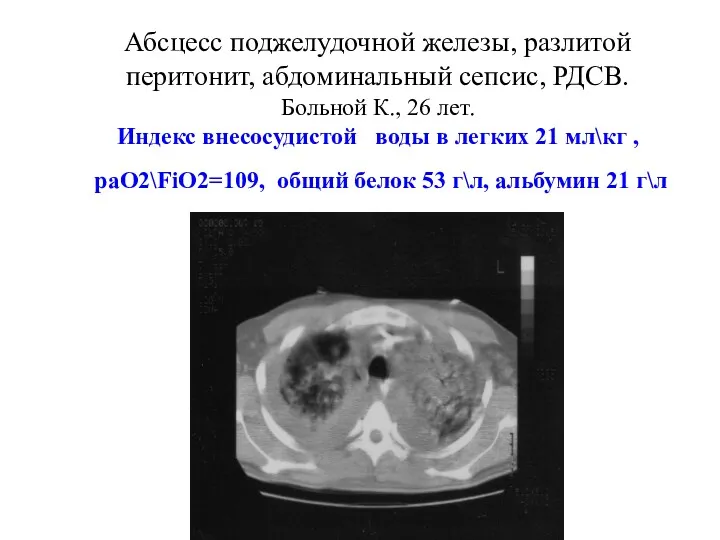 Абсцесс поджелудочной железы, разлитой перитонит, абдоминальный сепсис, РДСВ. Больной К., 26 лет. Индекс