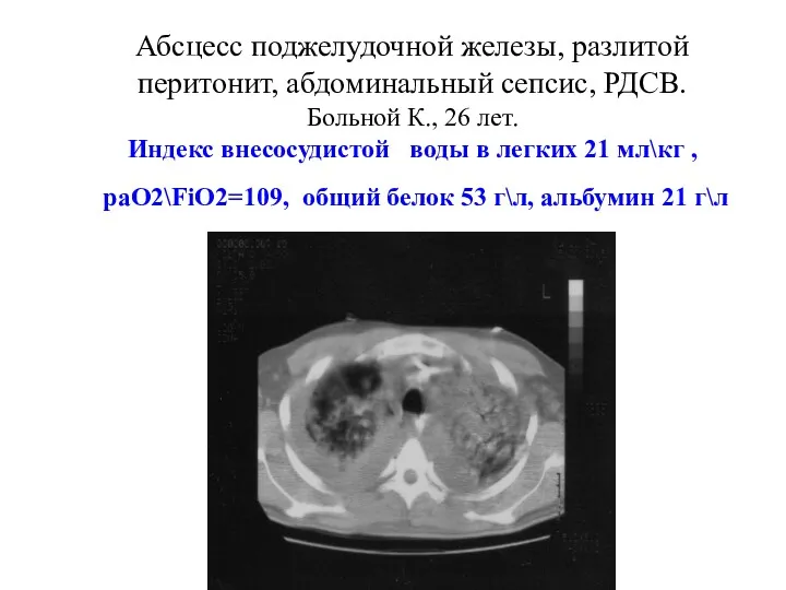 Абсцесс поджелудочной железы, разлитой перитонит, абдоминальный сепсис, РДСВ. Больной К.,