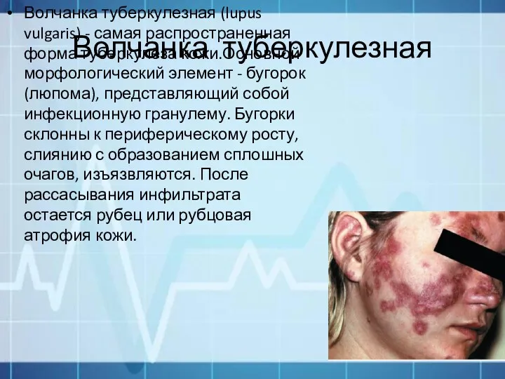 Волчанка туберкулезная Волчанка туберкулезная (lupus vulgaris) - самая распространенная форма