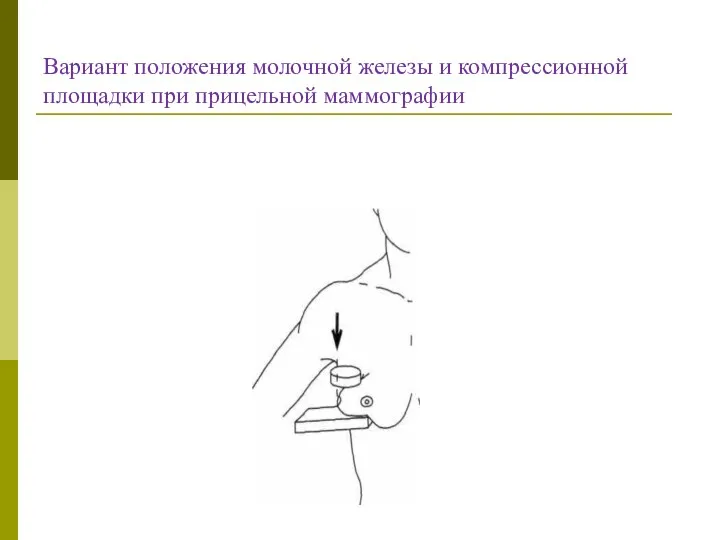 Вариант положения молочной железы и компрессионной площадки при прицельной маммографии