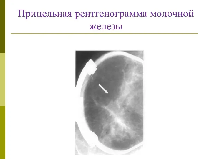 Прицельная рентгенограмма молочной железы