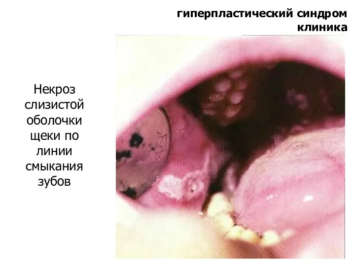 гиперпластический синдром клиника Некроз слизистой оболочки щеки по линии смыкания зубов