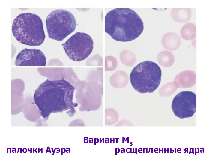 Вариант М3 палочки Ауэра расщепленные ядра