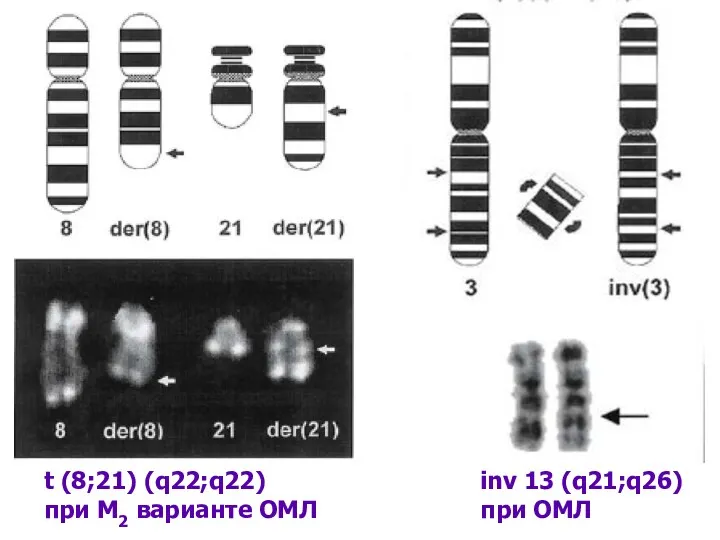 t (8;21) (q22;q22) при М2 варианте ОМЛ inv 13 (q21;q26) при ОМЛ