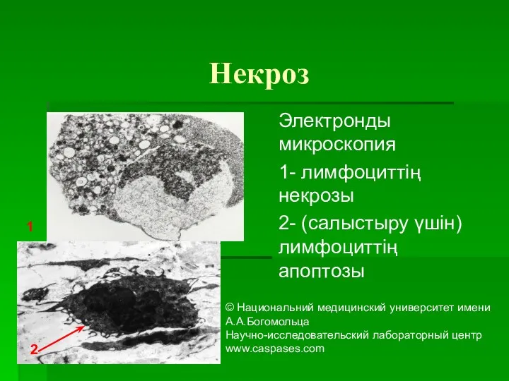 Некроз Электронды микроскопия 1- лимфоциттің некрозы 2- (салыстыру үшін) лимфоциттің