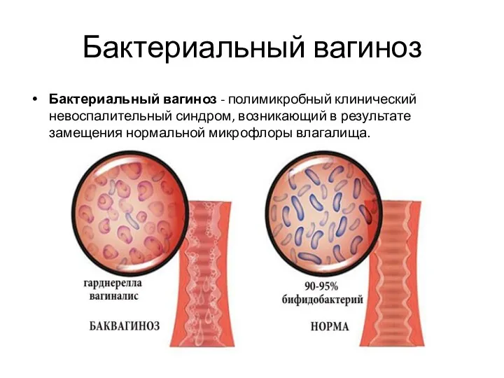 Бактериальный вагиноз Бактериальный вагиноз - полимикробный клинический невоспалительный синдром, возникающий в результате замещения нормальной микрофлоры влагалища.