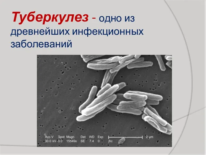 Туберкулез - одно из древнейших инфекционных заболеваний