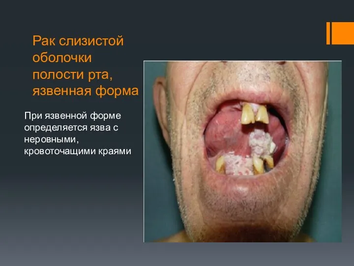 Рак слизистой оболочки полости рта, язвенная форма При язвенной форме определяется язва с неровными, кровоточащими краями
