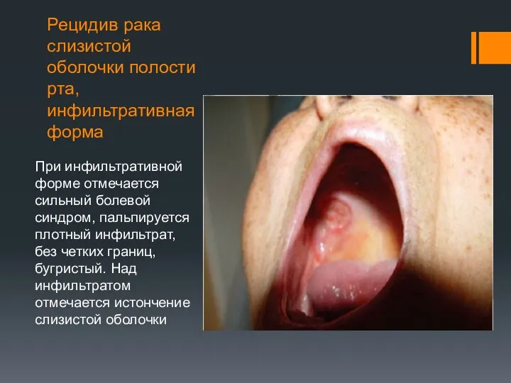 Рецидив рака слизистой оболочки полости рта, инфильтративная форма При инфильтративной форме отмечается сильный