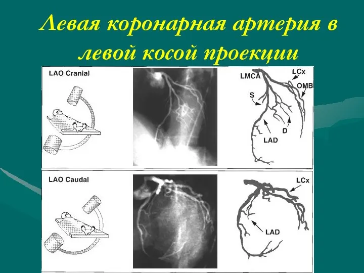 Левая коронарная артерия в левой косой проекции