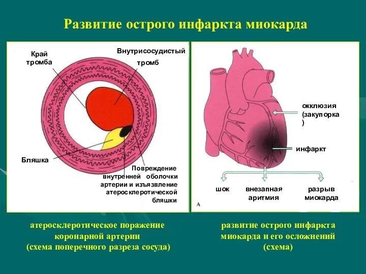 Развитие острого инфаркта миокарда Край тромба Внутрисосудистый тромб Бляшка Повреждение внутренней оболочки артерии