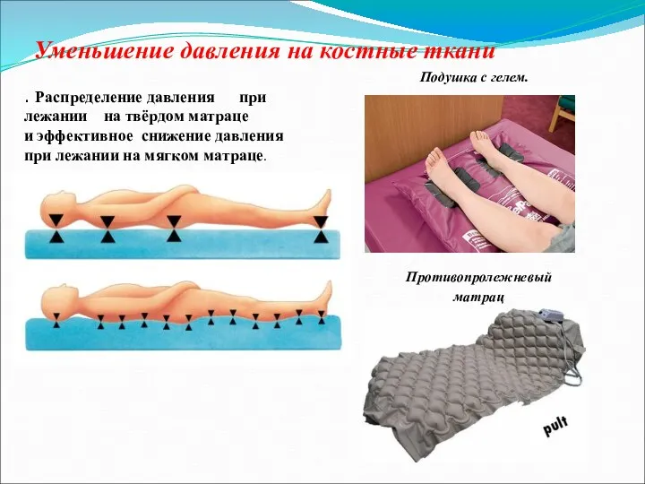 Уменьшение давления на костные ткани Подушка с гелем. Противопролежневый матрац