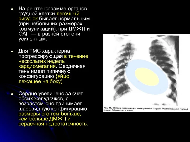 На рентгенограмме органов грудной клетки легочный рисунок бывает нормальным (при