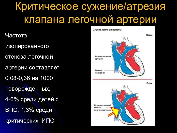 Критическое сужение/атрезия клапана легочной артерии Частота изолированного стеноза легочной артерии
