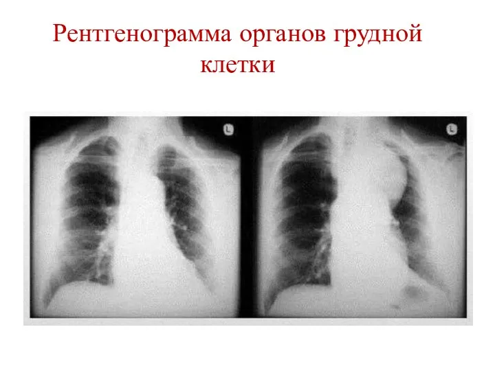 Рентгенограмма органов грудной клетки
