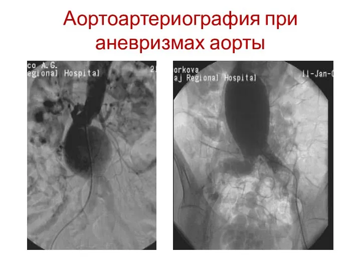 Аортоартериография при аневризмах аорты