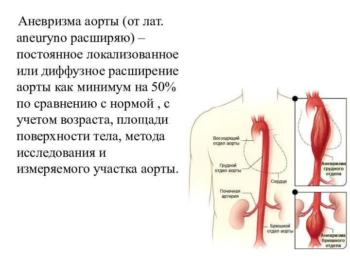 Аневризма аорты (от лат. aneuryno расширяю) – постоянное локализованное или