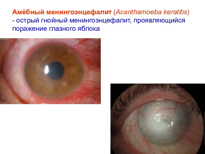 Амёбный менингоэнцефалит (Acanthamoeba keratitis) - острый гнойный менингоэнцефалит, проявляющийся поражение глазного яблока