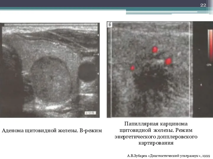 Аденома щитовидной железы. В-режим Папиллярная карцинома щитовидной железы. Режим энергетического допплеровского картирования А.В.Зубарев «Диагностический ультразвук», 1999