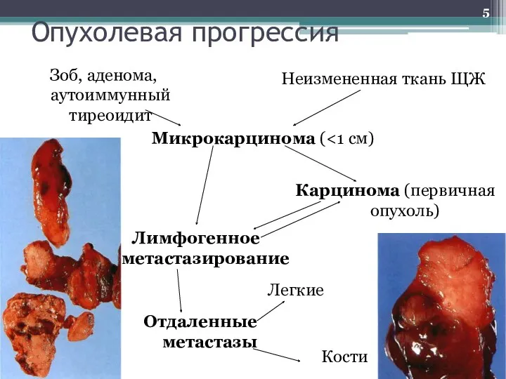 Опухолевая прогрессия Зоб, аденома, аутоиммунный тиреоидит Неизмененная ткань ЩЖ Микрокарцинома