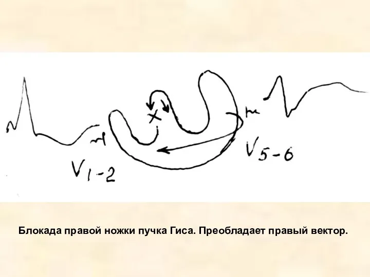 Блокада правой ножки пучка Гиса. Преобладает правый вектор.