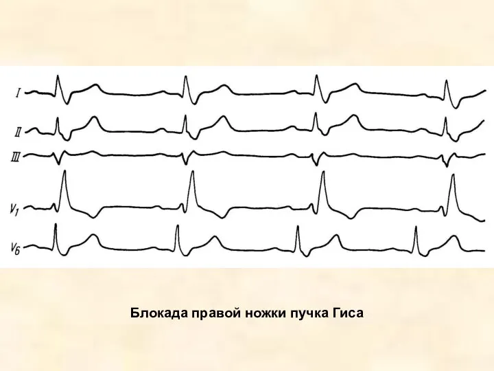 Блокада правой ножки пучка Гиса