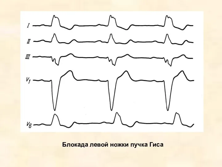 Блокада левой ножки пучка Гиса