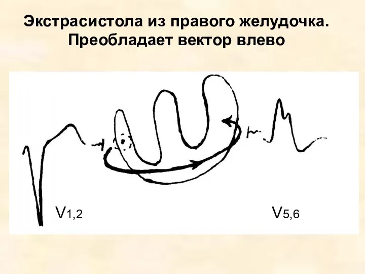 Экстрасистола из правого желудочка. Преобладает вектор влево V1,2 V5,6