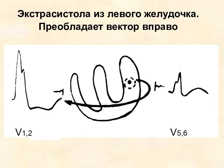 Экстрасистола из левого желудочка. Преобладает вектор вправо V1,2 V5,6