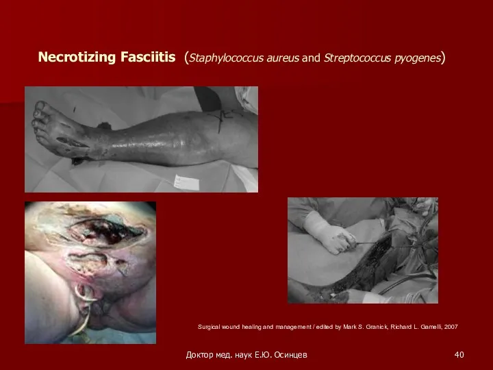 Доктор мед. наук Е.Ю. Осинцев Necrotizing Fasciitis (Staphylococcus aureus and Streptococcus pyogenes) Surgical