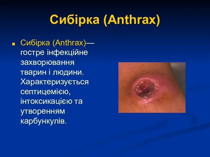 Сибірка (Anthrax) Сибірка (Anthrax)— гостре інфекційне захворювання тварин і людини. Характеризується септицемією, інтоксикацією та утворенням карбункулів.