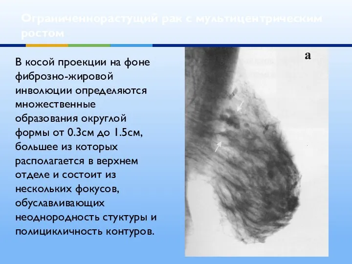 Ограниченнорастущий рак с мультицентрическим ростом В косой проекции на фоне