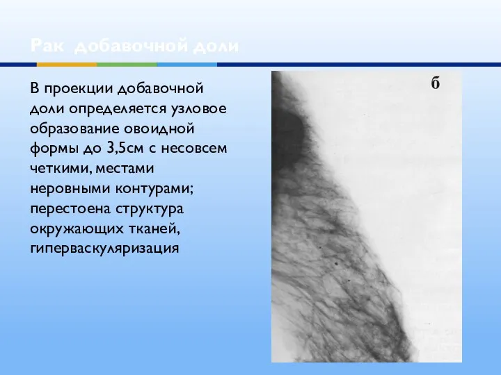 Рак добавочной доли В проекции добавочной доли определяется узловое образование