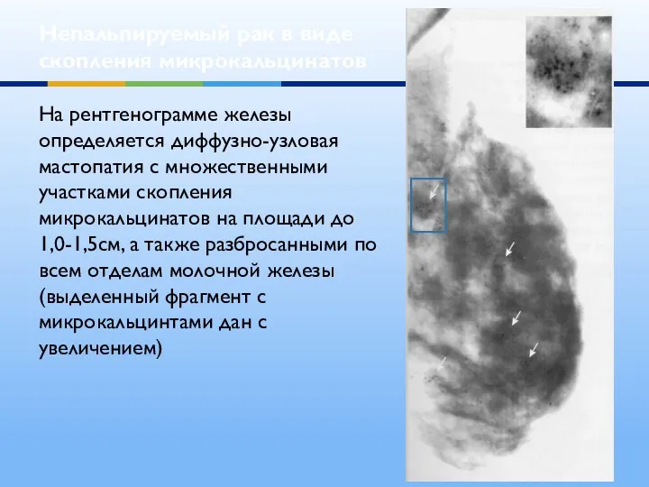 Непальпируемый рак в виде скопления микрокальцинатов На рентгенограмме железы определяется диффузно-узловая мастопатия с