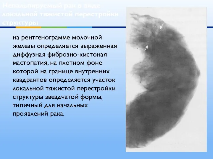 Непальпируемый рак в виде локальной тяжистой перестройки структуры на рентгенограмме молочной железы определяется