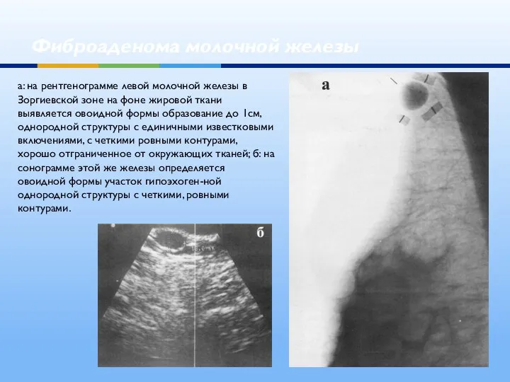 Фиброаденома молочной железы а: на рентгенограмме левой молочной железы в Зоргиевской зоне на